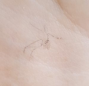 Image of a Tiger Mosquitoe imprint, on reporter Andrew Atkinson's wife Helen's arm, after being swotted in Los Montesinos.