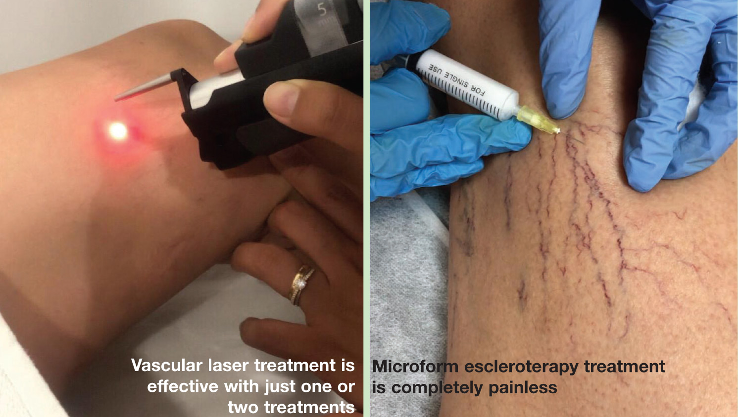 Vascular Laser Treatment and Microfoam sclerotherapy - Specialist treatments from NoVarices